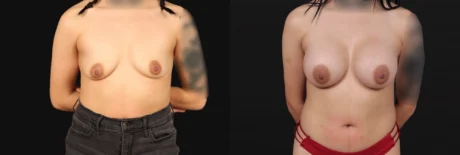 Breast Augmentation case #267157