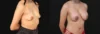 Breast Augmentation case #267157 slider thumbnail