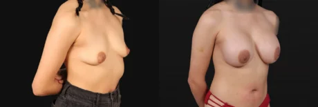 Breast Augmentation case #267157