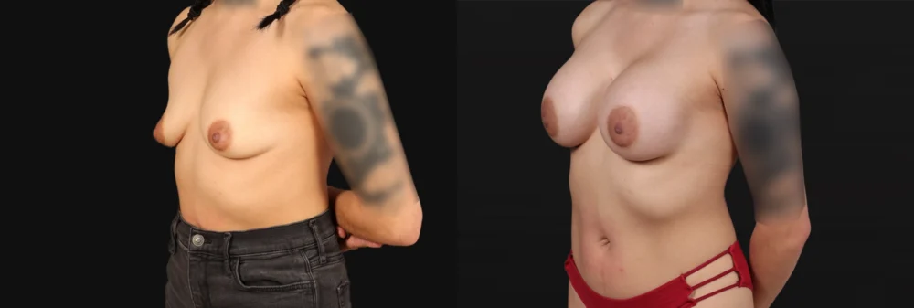 Breast Augmentation case #267157
