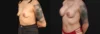 Breast Augmentation case #267157 slider thumbnail