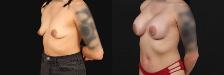 Breast Augmentation case #267157