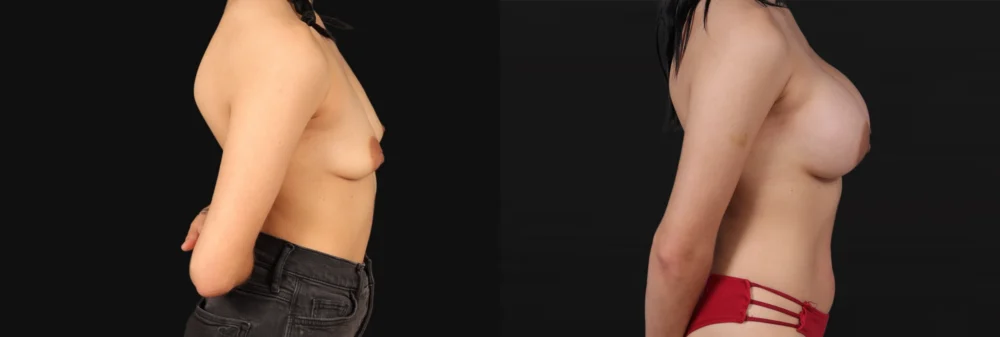 Breast Augmentation case #267157