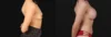 Breast Augmentation case #267157 slider thumbnail