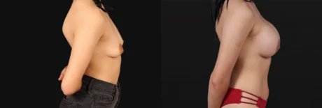 Breast Augmentation case #267157