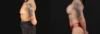 Breast Augmentation case #267157 slider thumbnail