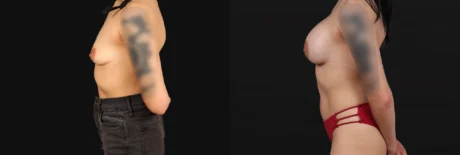Breast Augmentation case #267157