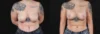 Breast Lift with Implants case #267182 slider thumbnail