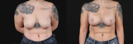 Breast Lift with Implants case #267182