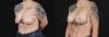 Breast Lift with Implants case #267182 slider thumbnail