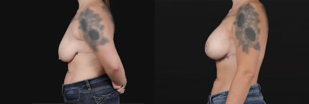 Breast Lift with Implants case #267182