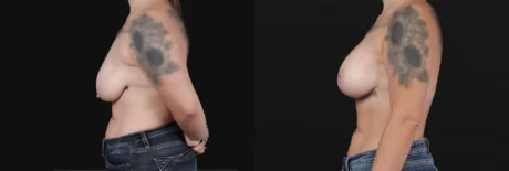 Breast Lift with Implants case #267182