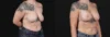 Breast Lift with Implants case #267182 slider thumbnail