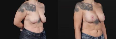 Breast Lift with Implants case #267182