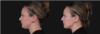 Submental Liposuction case #267259 slider thumbnail