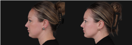 Submental Liposuction case #267259