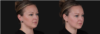 Submental Liposuction case #267259 slider thumbnail