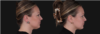 Submental Liposuction case #267259 slider thumbnail