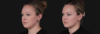 Submental Liposuction case #267259 slider thumbnail