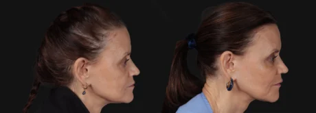 Filler case #267352