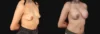 Breast Augmentation case #267157 slider thumbnail