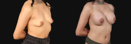 Breast Augmentation case #267157