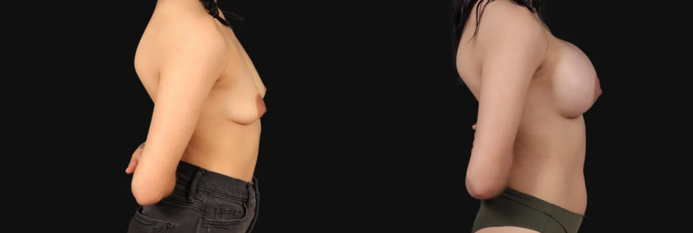 Breast Augmentation case #267157