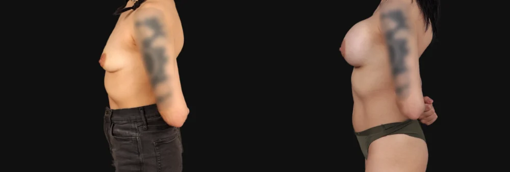 Breast Augmentation case #267157