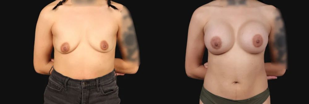 Breast Augmentation case #267157