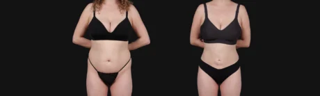 Brazilian Butt Lift case #267619