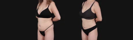 Brazilian Butt Lift case #267619