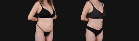 Brazilian Butt Lift case #267619