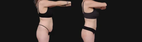 Brazilian Butt Lift case #267619