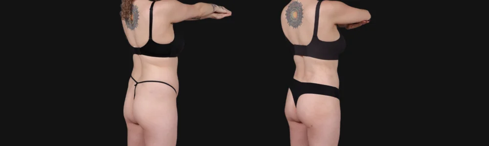 Brazilian Butt Lift case #267619