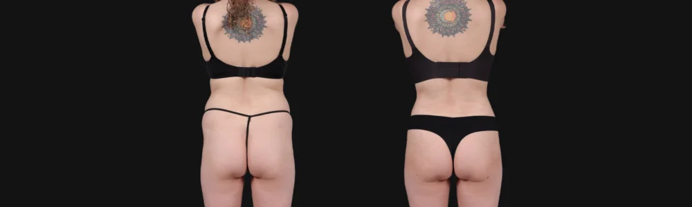 Brazilian Butt Lift case #267619
