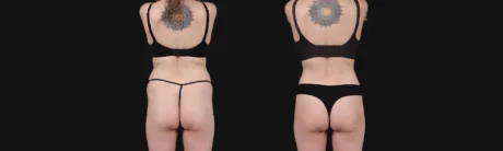 Brazilian Butt Lift case #267619