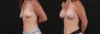 Breast Augmentation case #267824 slider thumbnail