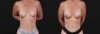 Breast Augmentation case #267824 slider thumbnail