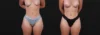 Liposuction case #267813 slider thumbnail