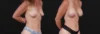 Breast Augmentation case #267824 slider thumbnail