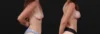 Breast Augmentation case #267824 slider thumbnail