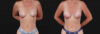 Breast Augmentation case #267824 slider thumbnail
