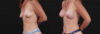 Breast Augmentation case #267824 slider thumbnail