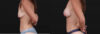 Breast Augmentation case #267824 slider thumbnail
