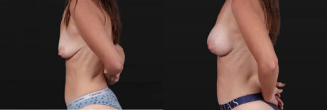 Breast Augmentation case #267824