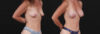 Breast Augmentation case #267824 slider thumbnail