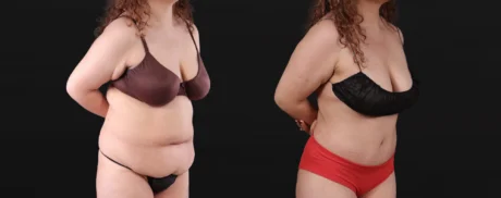 Post Bariatric Surgery (Massive Weight Loss) case #267780