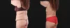 Post Bariatric Surgery (Massive Weight Loss) case #267780 slider thumbnail