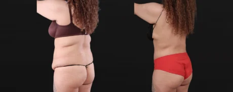 Post Bariatric Surgery (Massive Weight Loss) case #267780