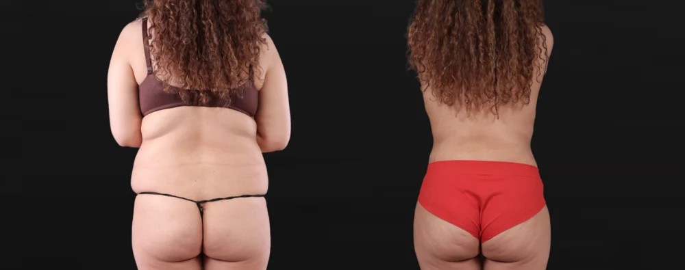 Post Bariatric Surgery (Massive Weight Loss) case #267780